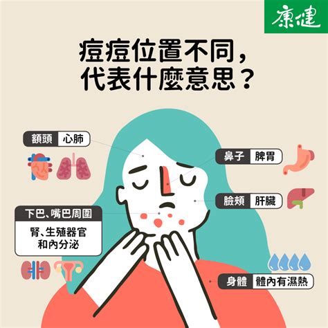 痘痘 位置|痘痘一直好不了？痘痘位置代表什麼？醫師2招治療痘。